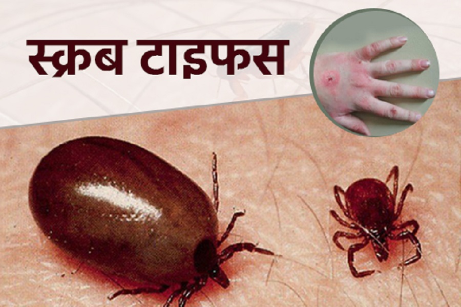 Chitwan reports 165 scrub typhus patients in three and half months